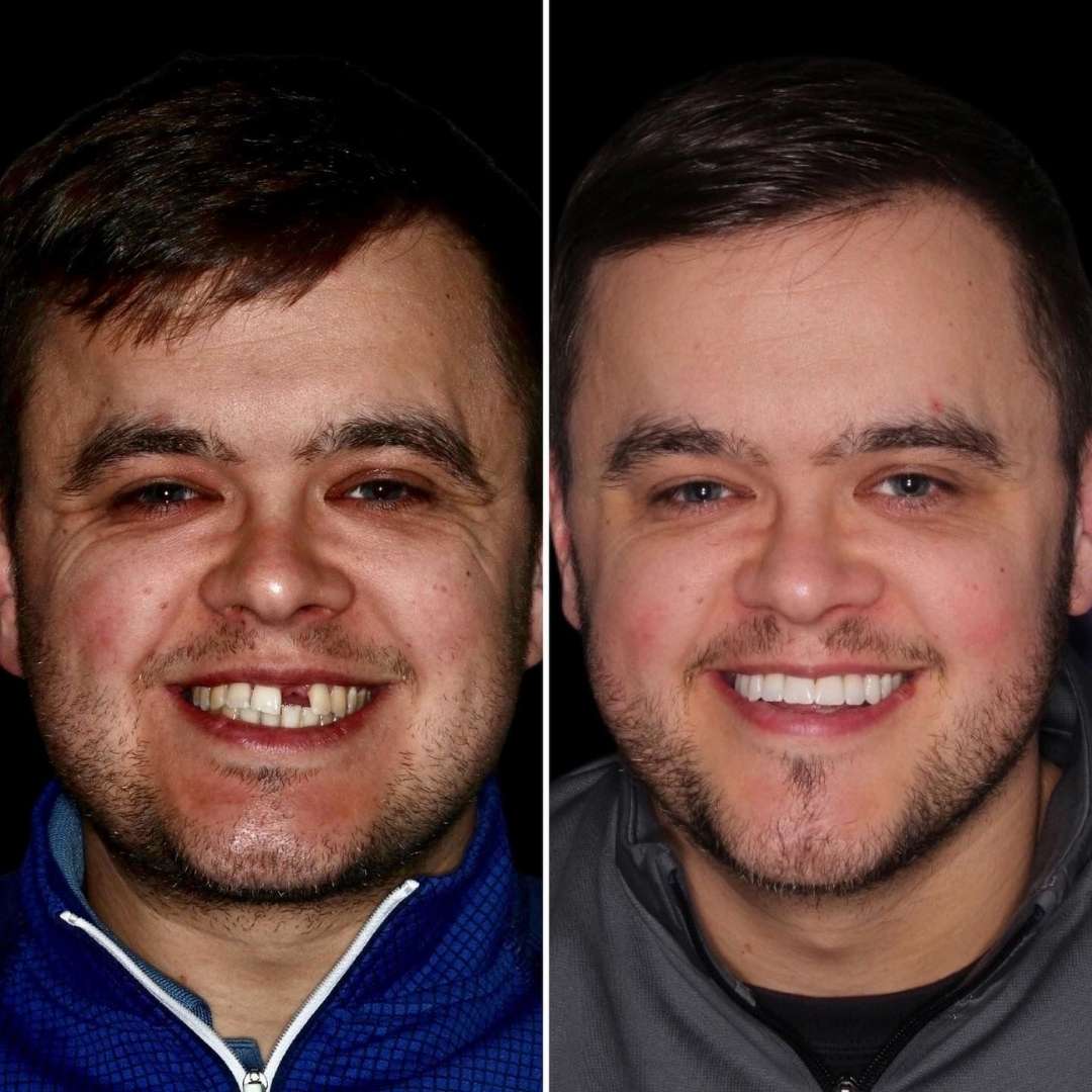 Before and after treatment