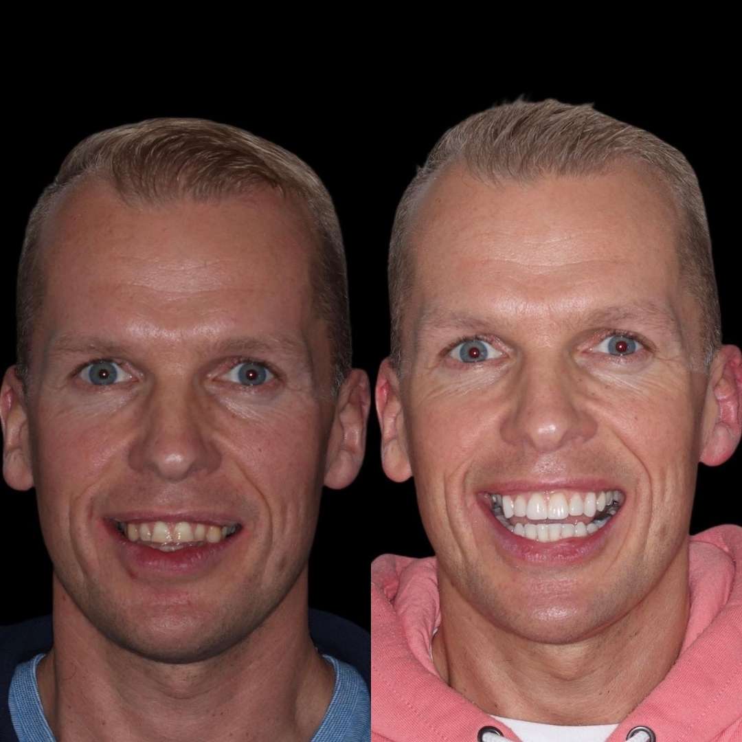 Before and after treatment