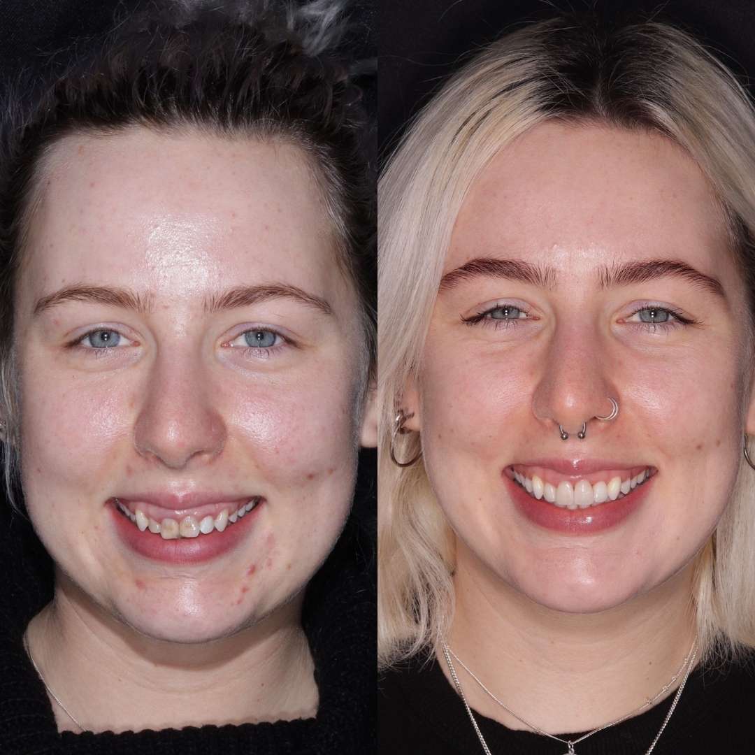 Before and after treatment