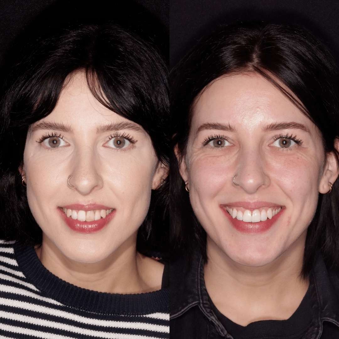 Tooth whitening and veneers