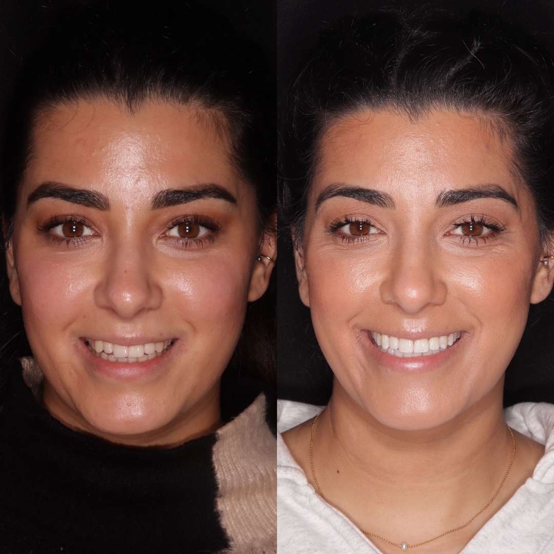 Clear aligners and tooth whitening