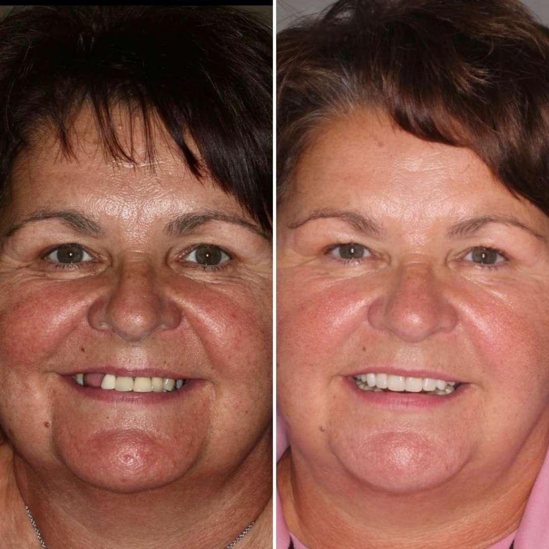 Before and after treatment