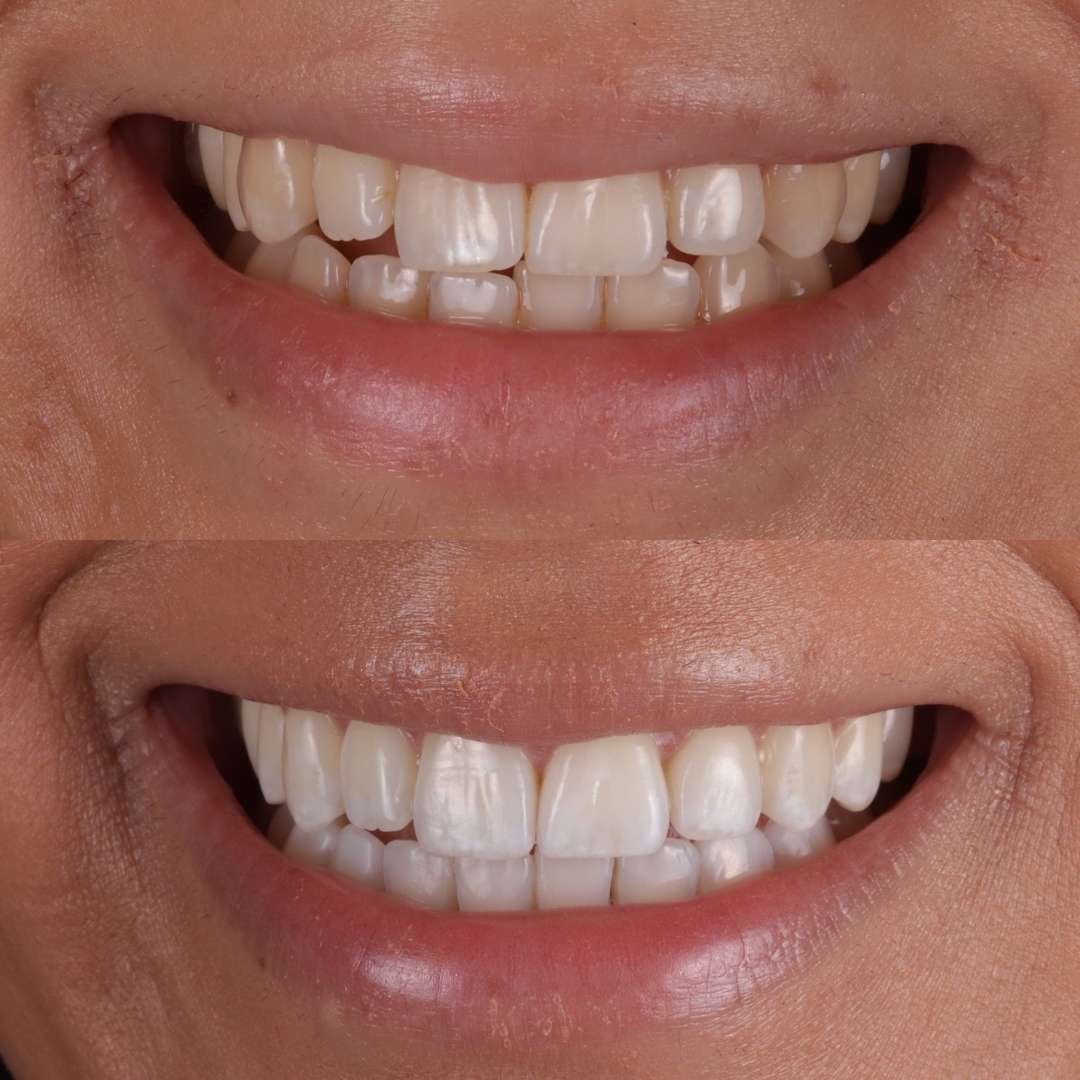 Dentistry On The Square, Pain Free Dentist Glasgow - Porcelain Veneers Dentistry On The Square, Pain Free Dentist Glasgow - Porcelain Veneers