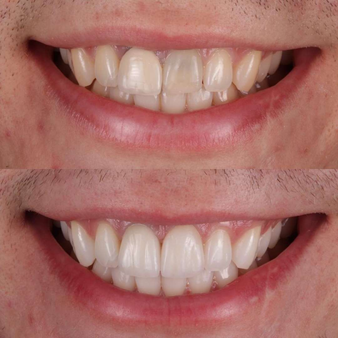 Dentistry On The Square, Pain Free Dentist Glasgow - Porcelain Veneers Dentistry On The Square, Pain Free Dentist Glasgow - Porcelain Veneers