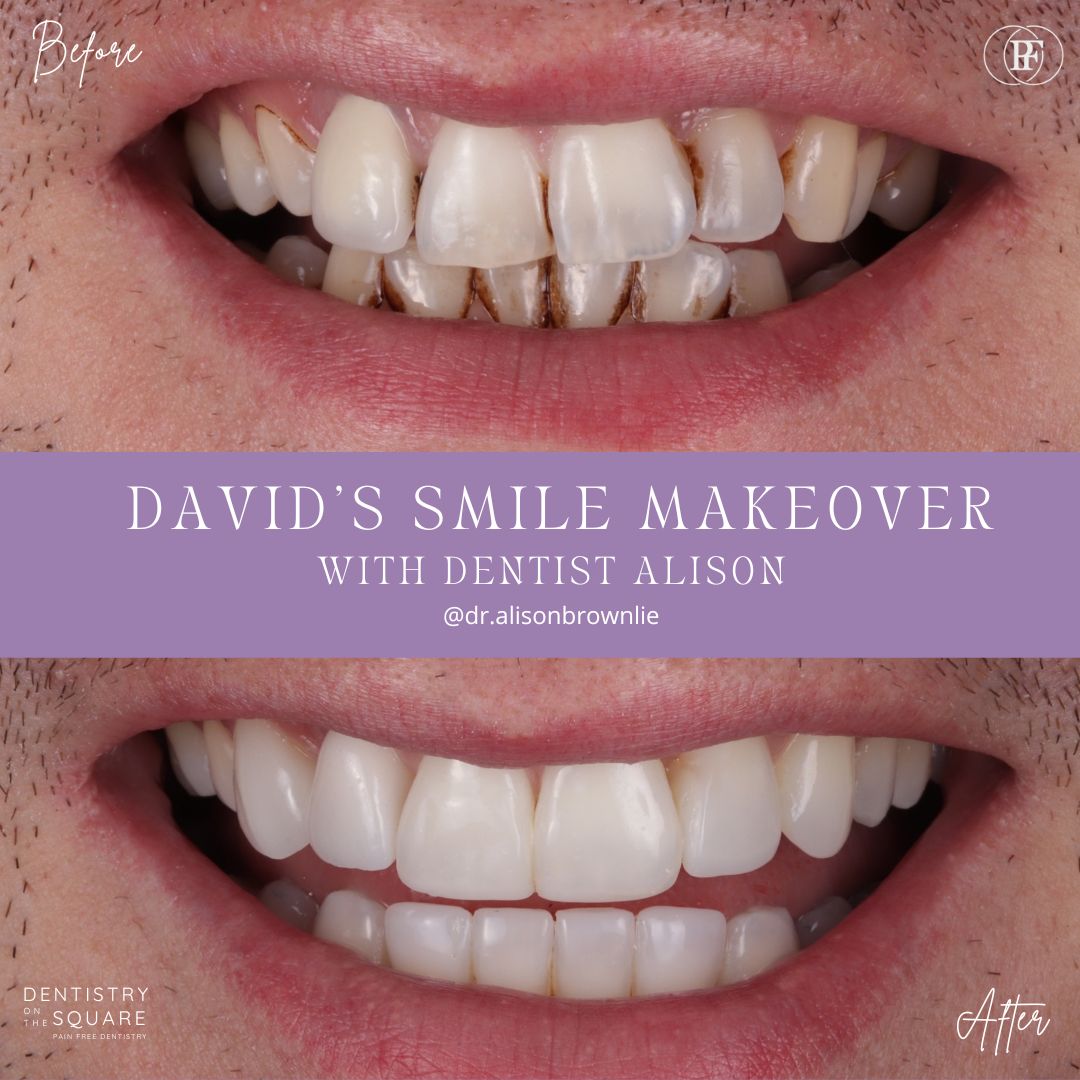 Dentistry On The Square, Pain Free Dentist Glasgow - David's Smile Makeover