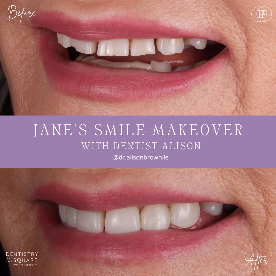 Dentistry On The Square, Pain Free Dentist Glasgow - Jane's Smile Makeover