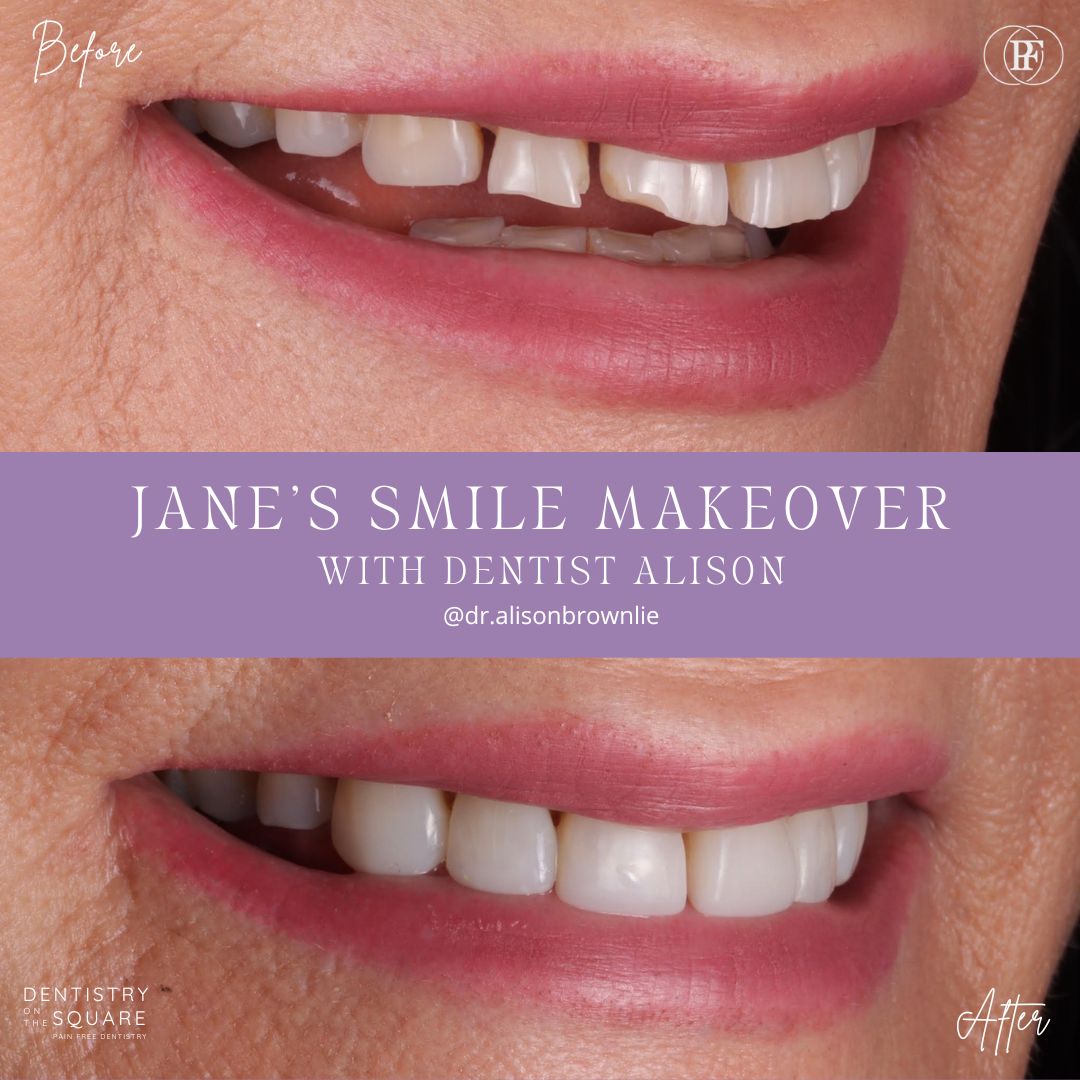 Dentistry On The Square, Pain Free Dentist Glasgow - Jane's Smile Makeover
