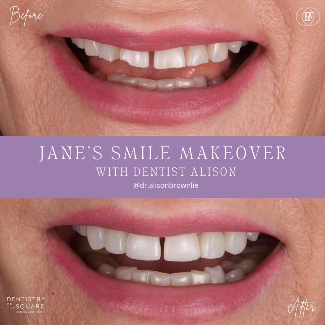 Dentistry On The Square, Pain Free Dentist Glasgow - Jane's Smile Makeover
