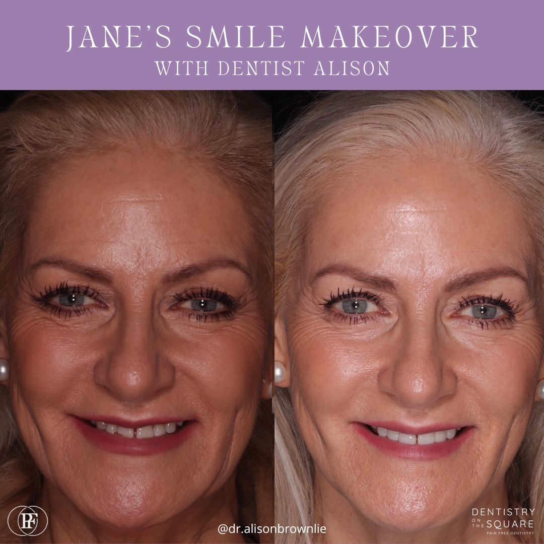 Jane's smile makeover