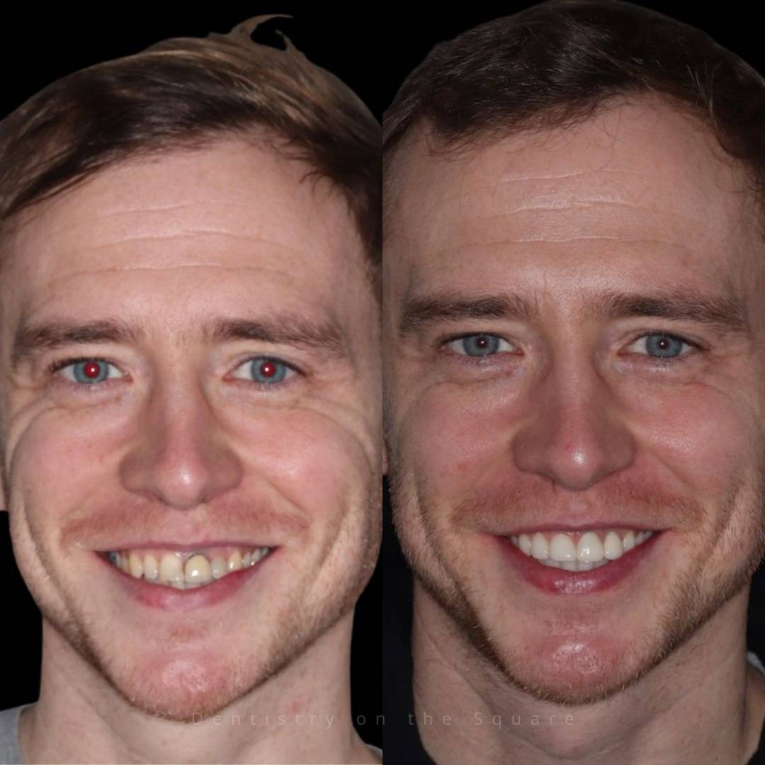 Dentistry On The Square, Pain Free Dentist Glasgow - Smile Gallery
