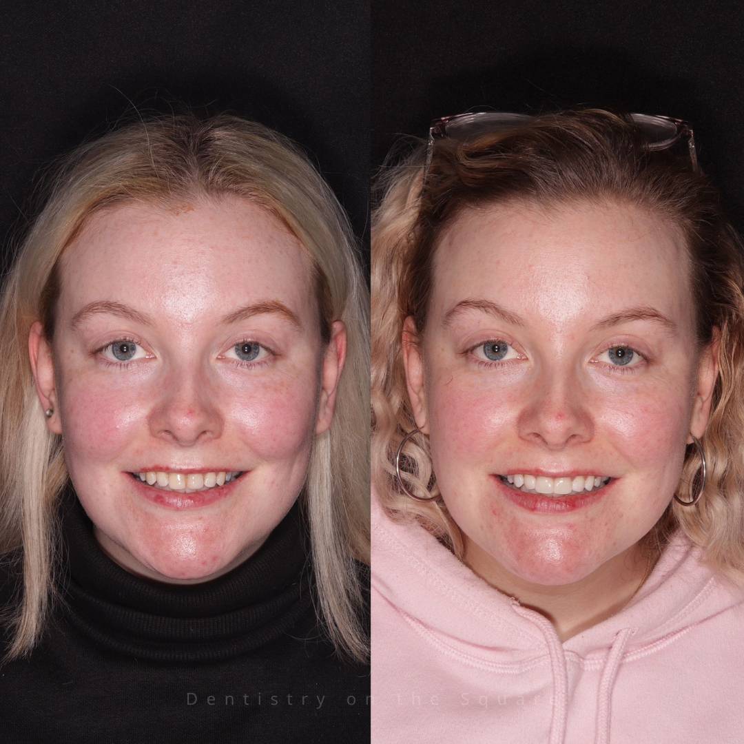 Dentistry On The Square, Pain Free Dentist Glasgow - Smile Gallery