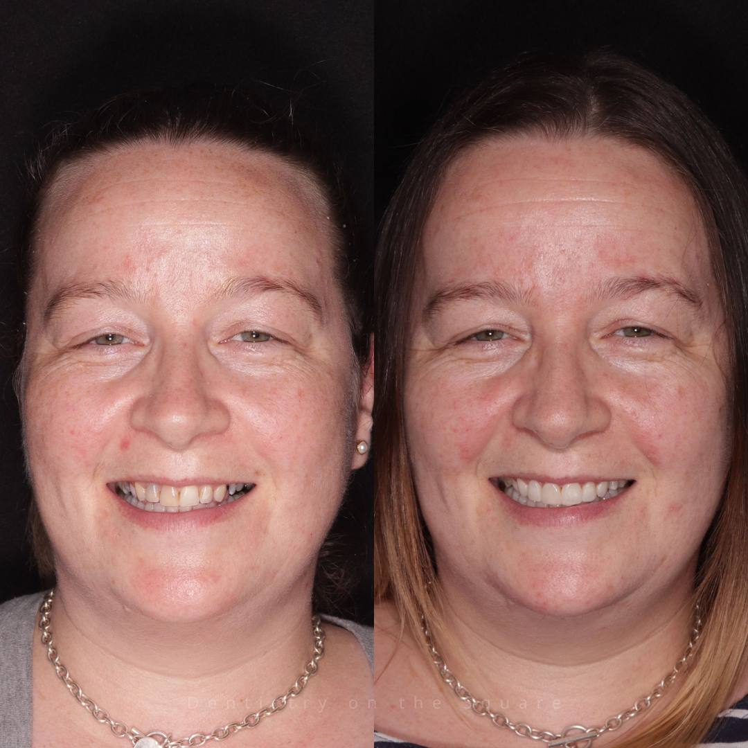 Dentistry On The Square, Pain Free Dentist Glasgow - Smile Gallery