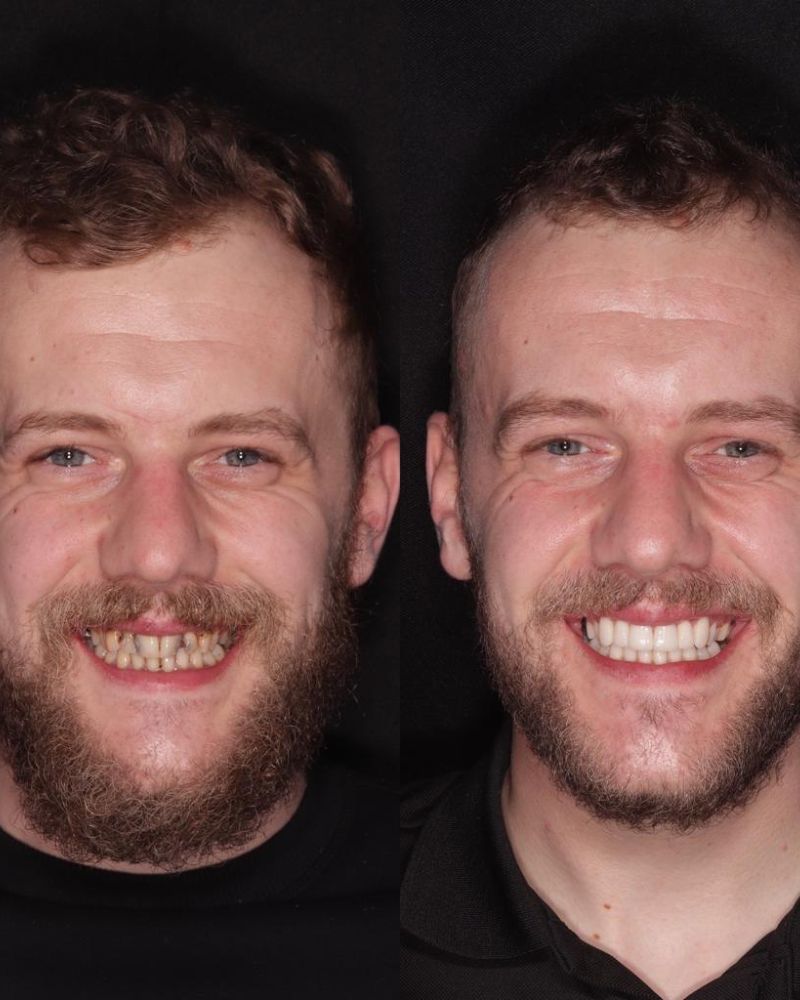 Before & after treatment with Alison