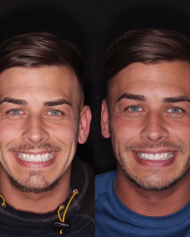 Before & after treatment with Alison