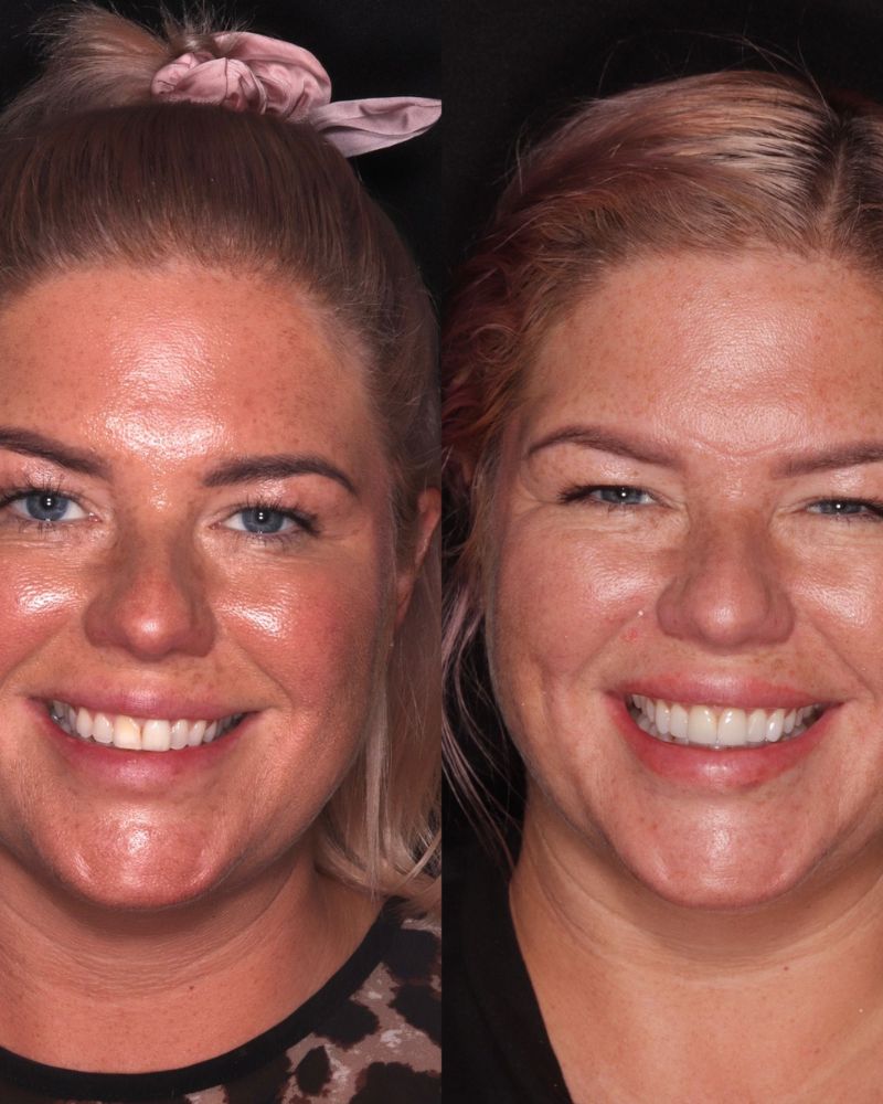 Before & after treatment with Alison