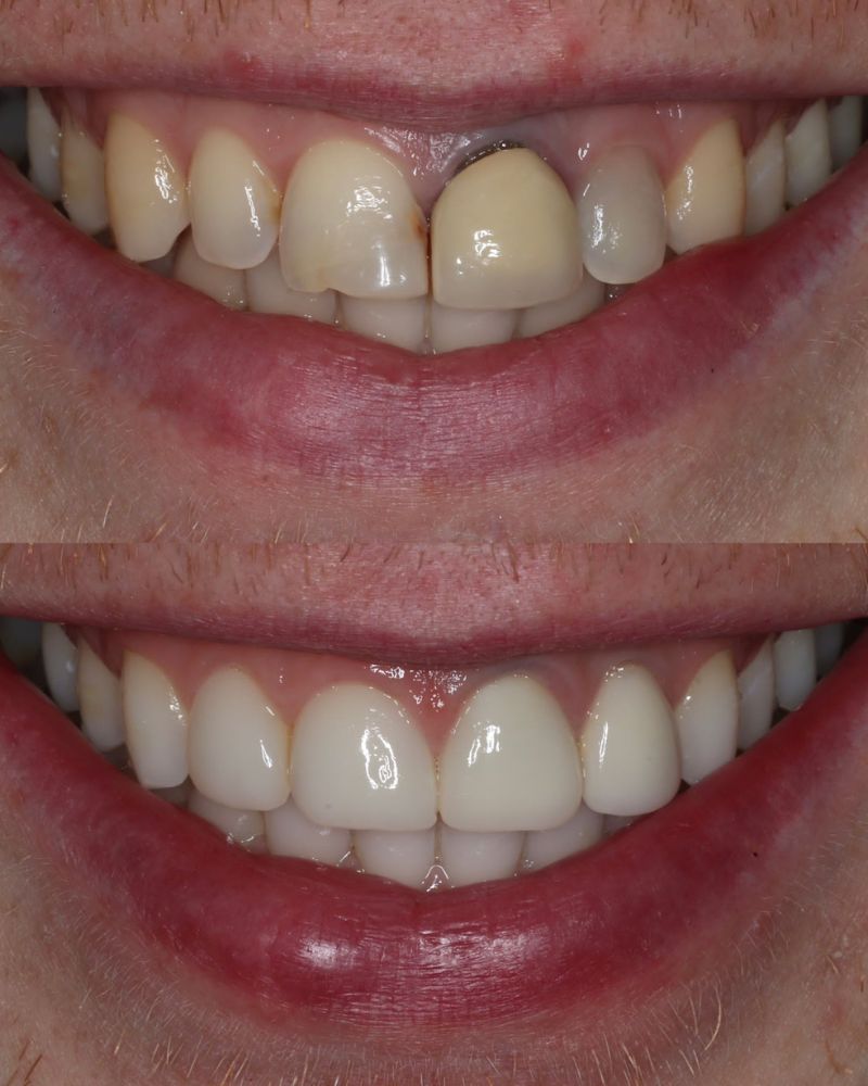 Before & after treatment with Andy