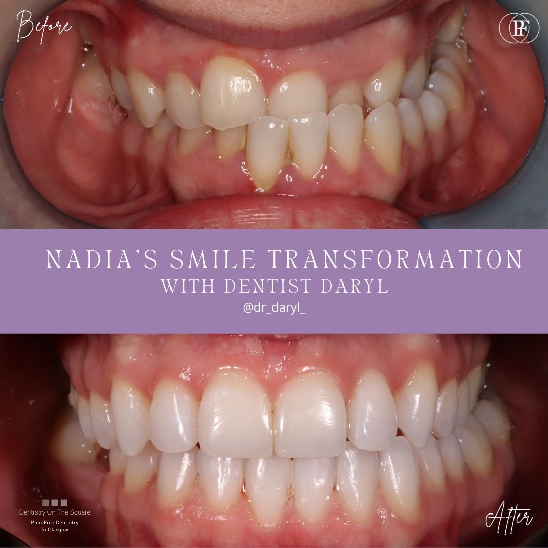 Dentistry On The Square, Pain Free Dentist Glasgow - Nadia's Smile Makeover