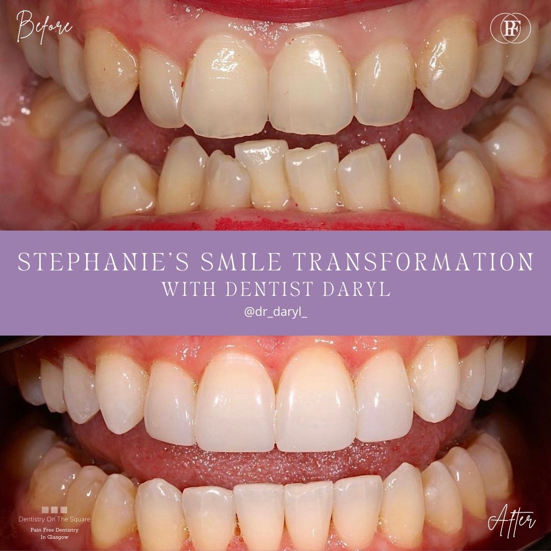 Dentistry On The Square, Pain Free Dentist Glasgow - Stephanie's Smile Makeover