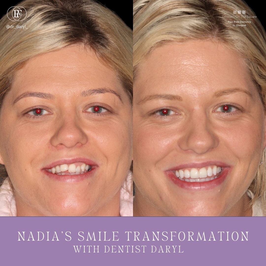 Dentistry On The Square, Pain Free Dentist Glasgow - Nadia's Smile Makeover