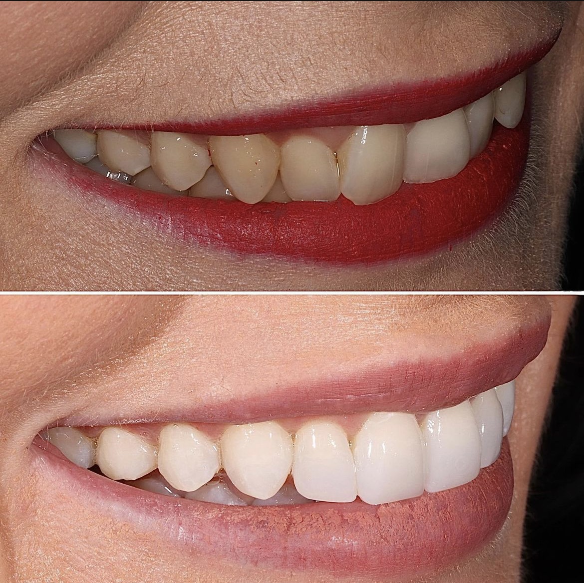 Dentistry On The Square, Pain Free Dentist Glasgow - Stephanie's Smile Makeover