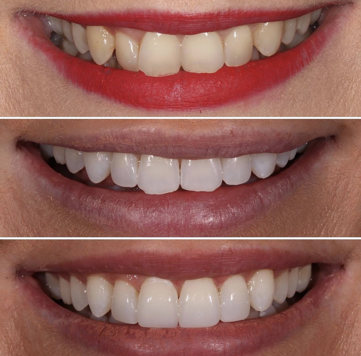 Dentistry On The Square, Pain Free Dentist Glasgow - Stephanie's Smile Makeover
