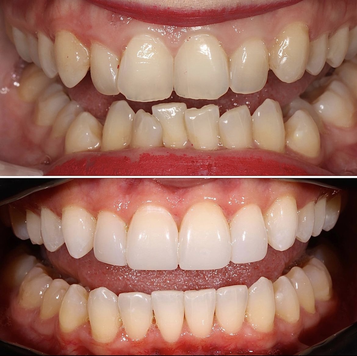 Dentistry On The Square, Pain Free Dentist Glasgow - Stephanie's Smile Makeover