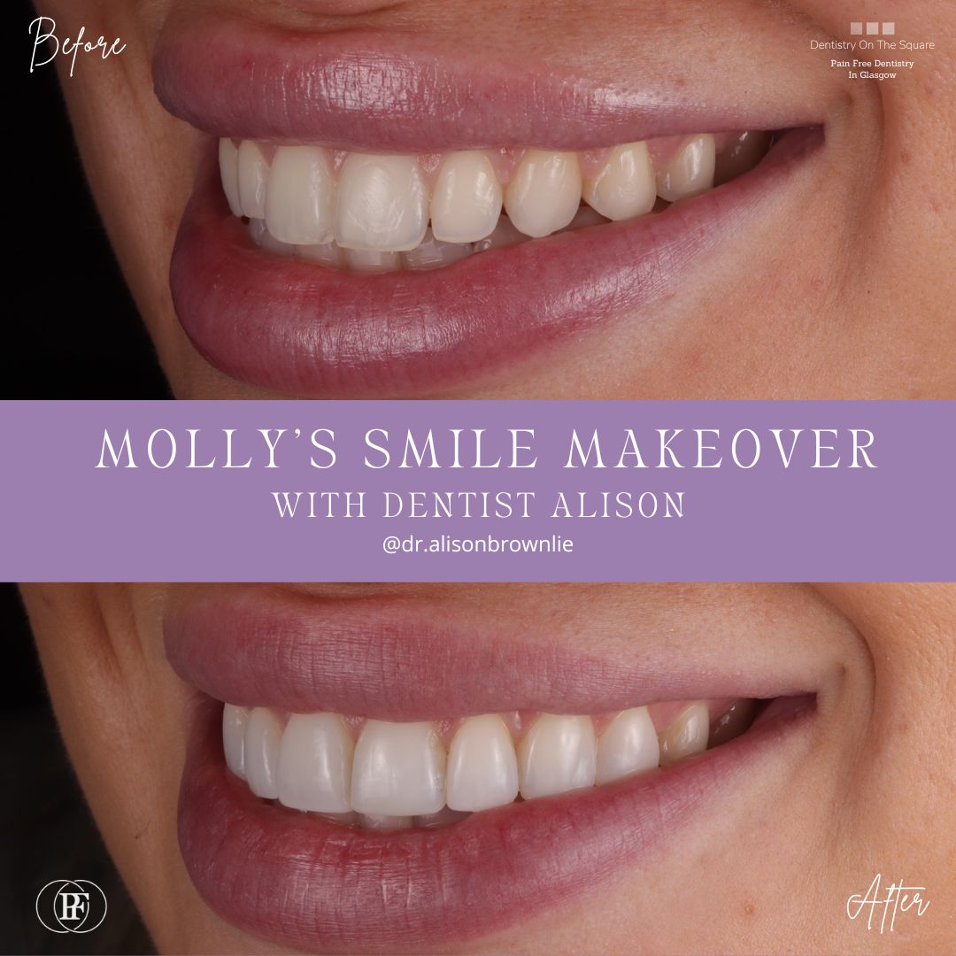 Dentistry On The Square, Pain Free Dentist Glasgow - Molly's Smile Makeover