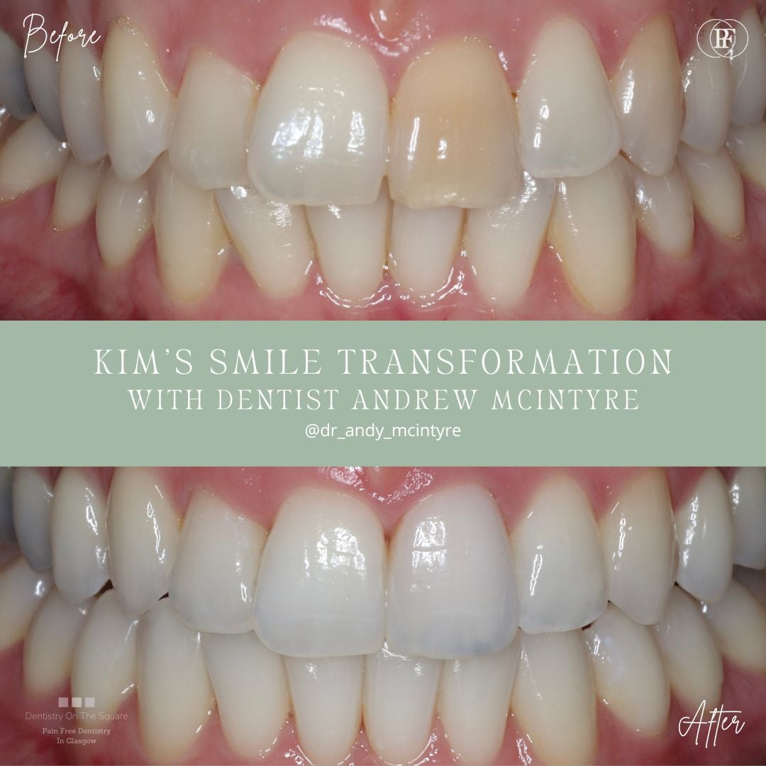 Dentistry On The Square, Pain Free Dentist Glasgow - Kim's Smile Story