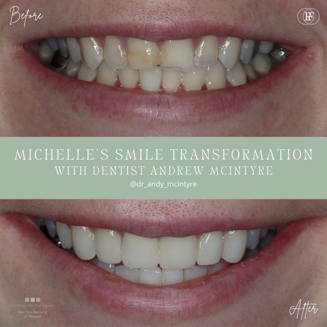 Dentistry On The Square, Pain Free Dentist Glasgow - Michelle's Smile Story