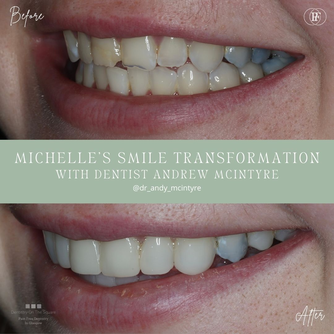 Dentistry On The Square, Pain Free Dentist Glasgow - Michelle's Smile Story