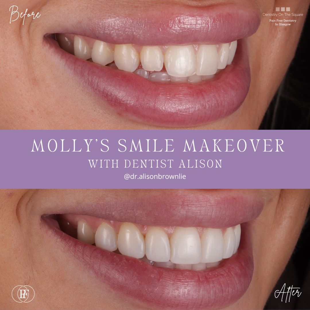 Dentistry On The Square, Pain Free Dentist Glasgow - Molly's Smile Makeover