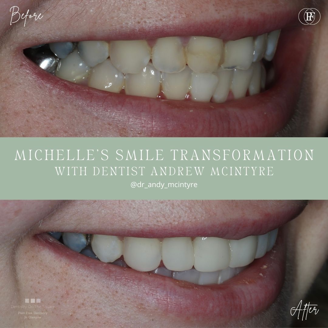 Dentistry On The Square, Pain Free Dentist Glasgow - Michelle's Smile Story