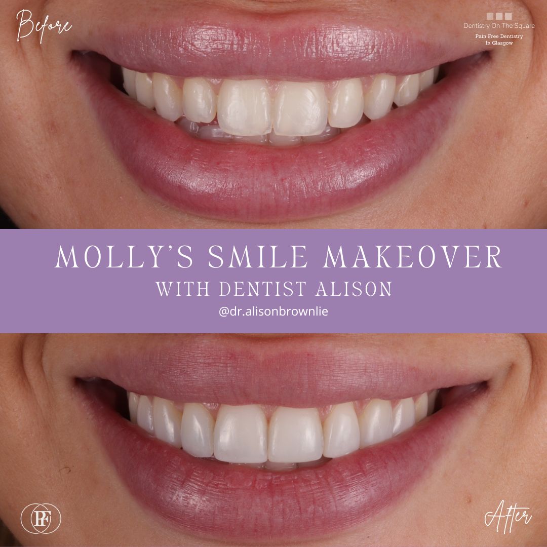 Dentistry On The Square, Pain Free Dentist Glasgow - Molly's Smile Makeover