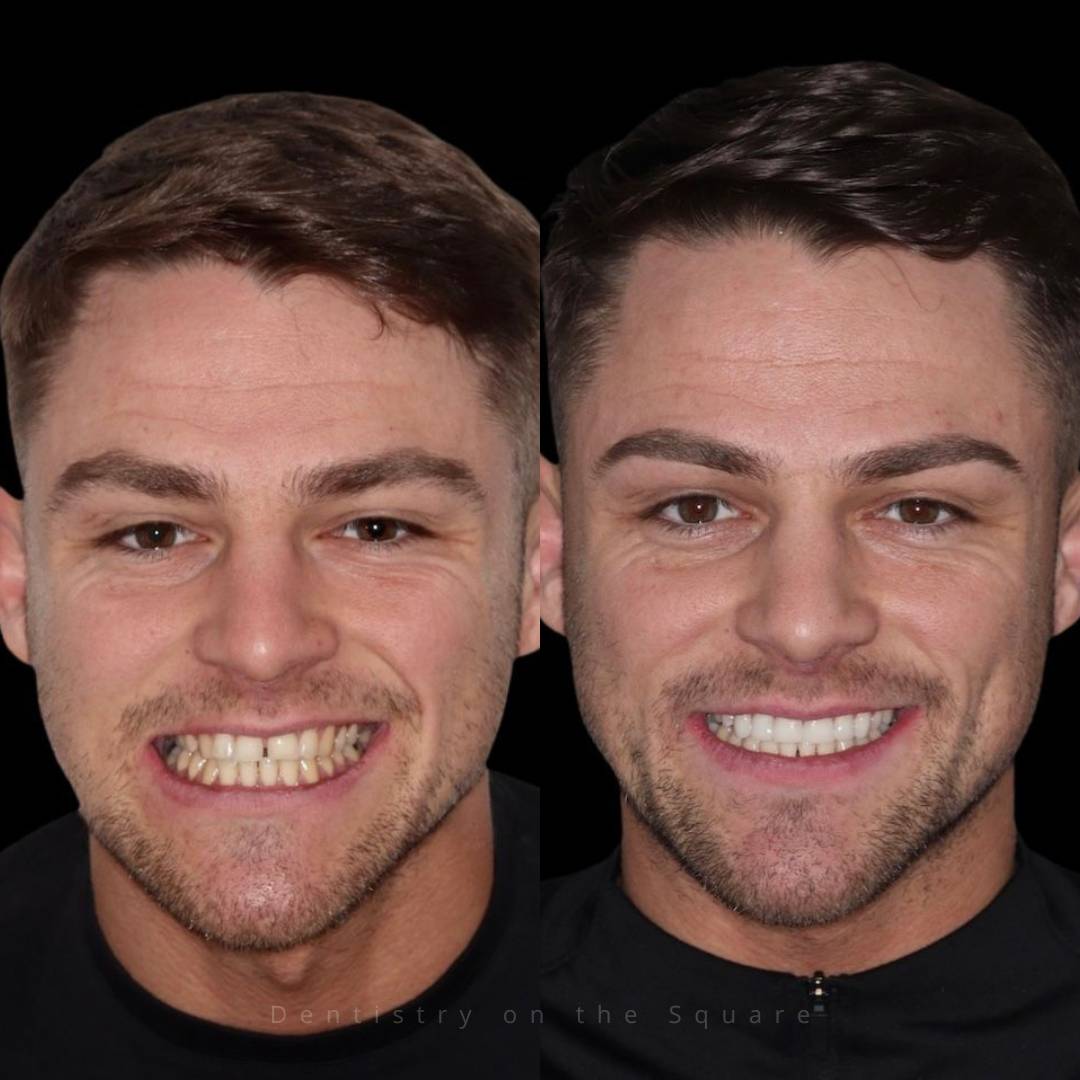 Clear aligners, tooth whitening, composite bonding