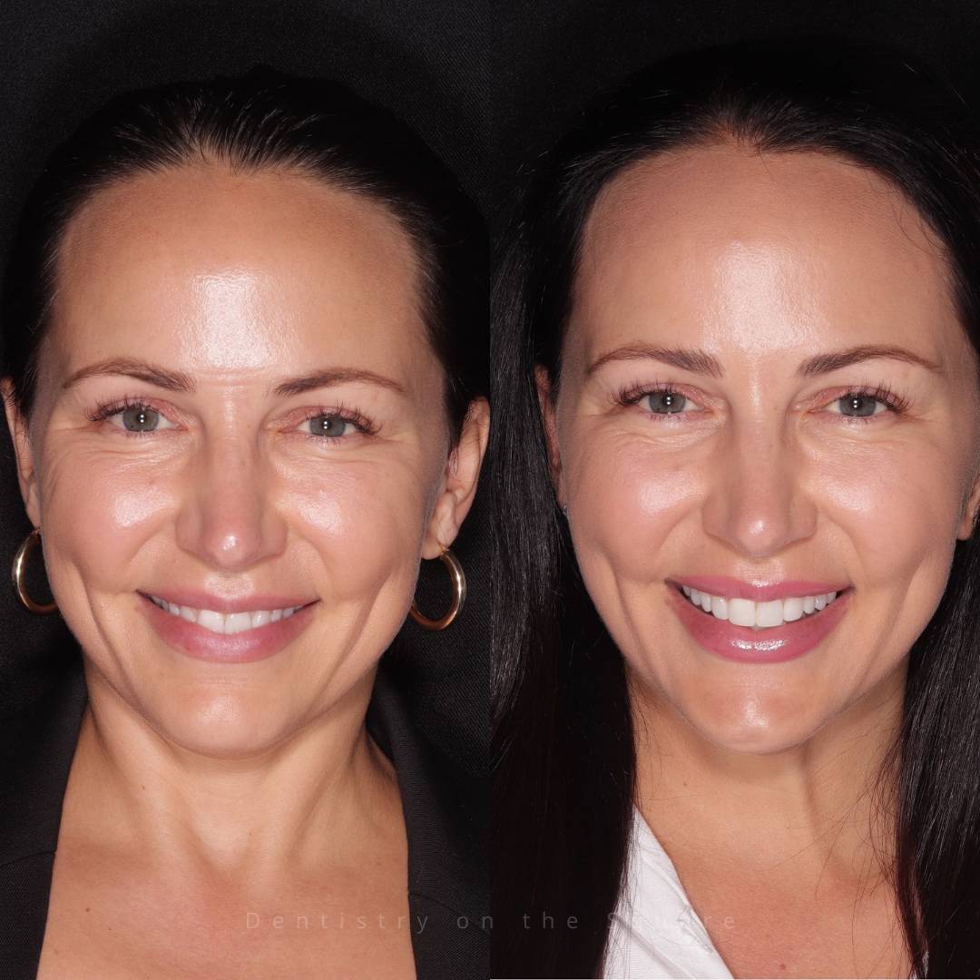 Tooth whitening, trial smile, composite bonding