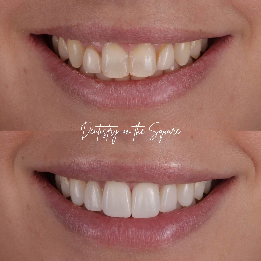 Dentistry On The Square, Pain Free Dentist Glasgow - Request A Complimentary Consultation Before and after treatment at Dentistry On The Square in Glasgow