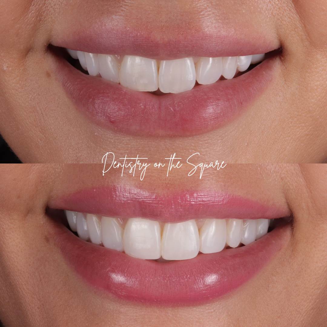 Dentistry On The Square, Pain Free Dentist Glasgow - Request A Complimentary Consultation Before and after treatment at Dentistry On The Square in Glasgow