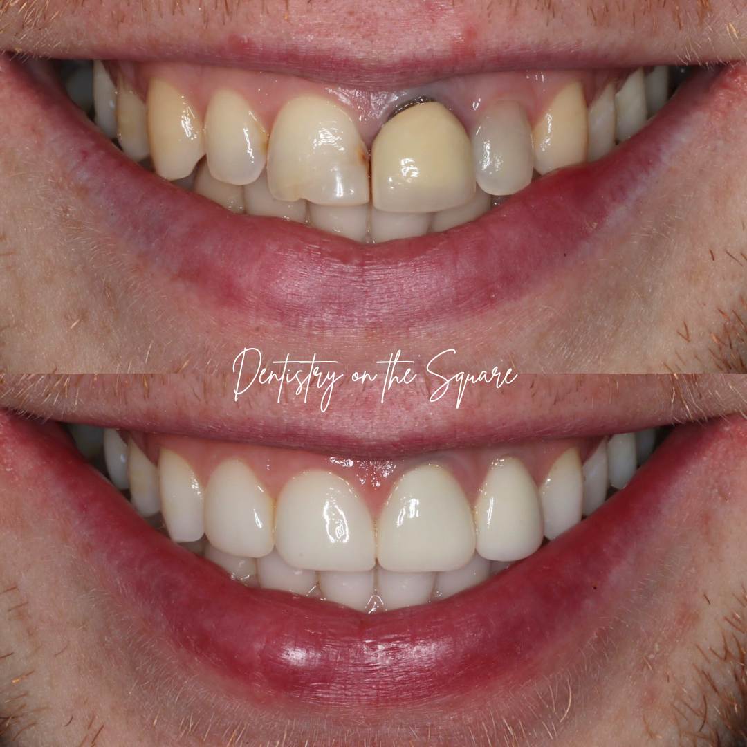 Dentistry On The Square, Pain Free Dentist Glasgow - Request A Complimentary Consultation Before and after treatment at Dentistry On The Square in Glasgow