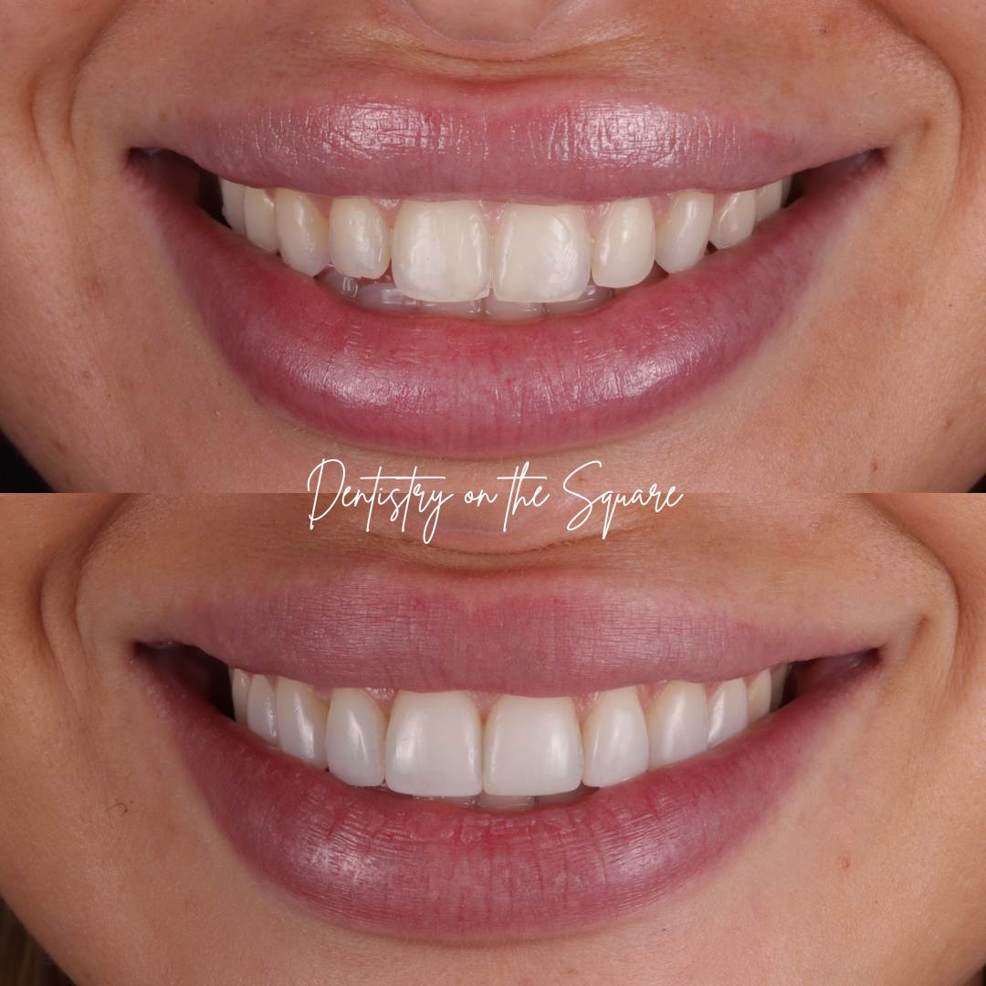 Dentistry On The Square, Pain Free Dentist Glasgow - Request A Complimentary Consultation Before and after treatment at Dentistry On The Square in Glasgow