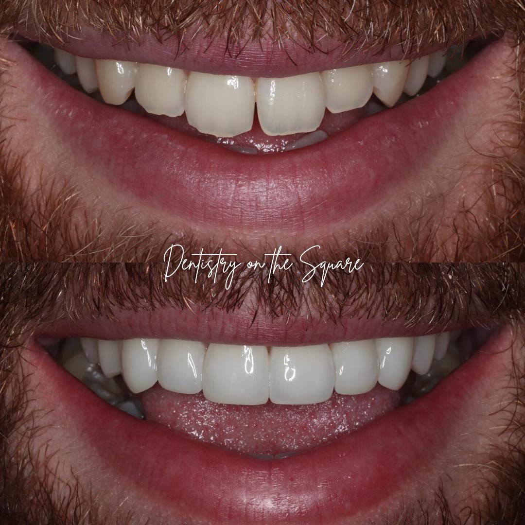Dentistry On The Square, Pain Free Dentist Glasgow - Request A Complimentary Consultation Before and after treatment at Dentistry On The Square in Glasgow