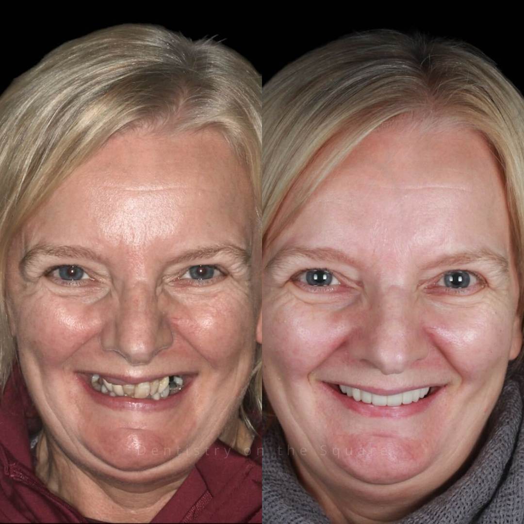 Dentistry On The Square, Pain Free Dentist Glasgow - Smile Gallery
