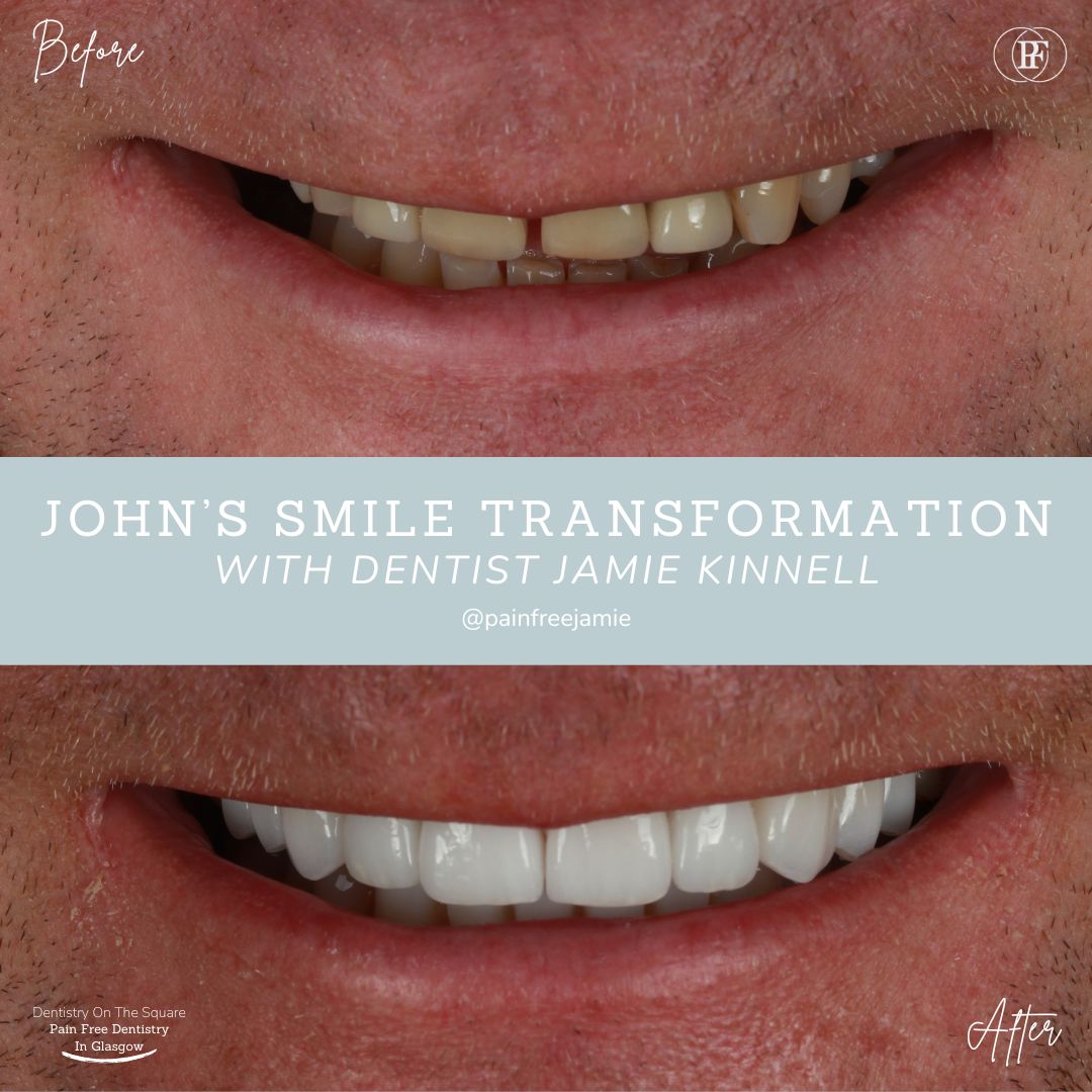 Dentistry On The Square, Pain Free Dentist Glasgow - John's Smile Story