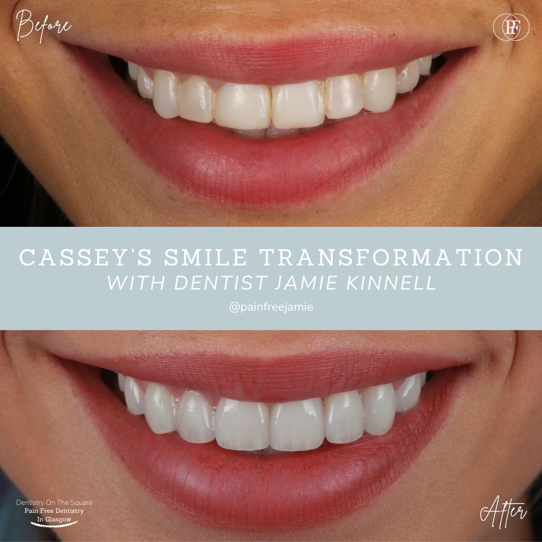 Dentistry On The Square, Pain Free Dentist Glasgow - Cassey's Smile Story