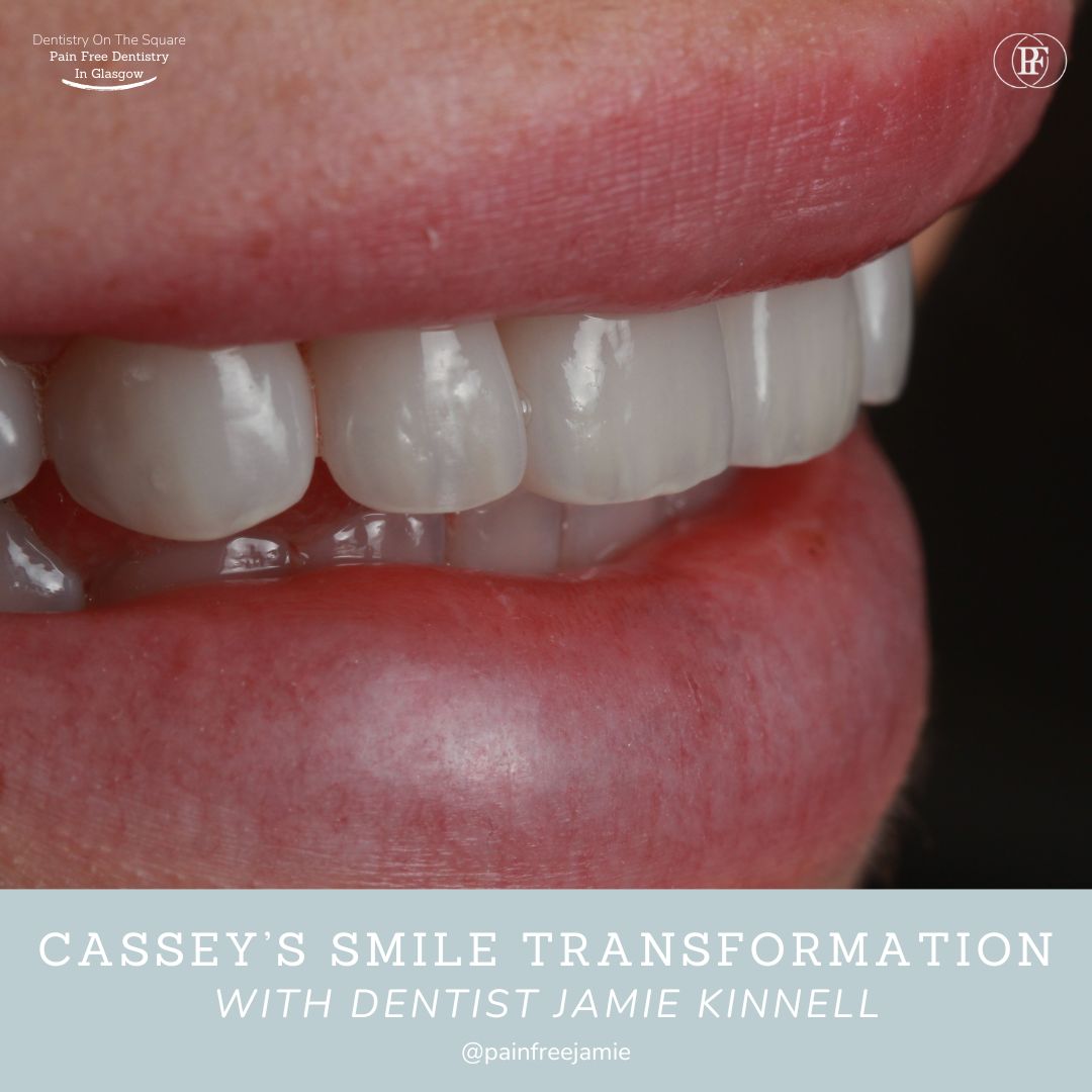 Dentistry On The Square, Pain Free Dentist Glasgow - Cassey's Smile Story