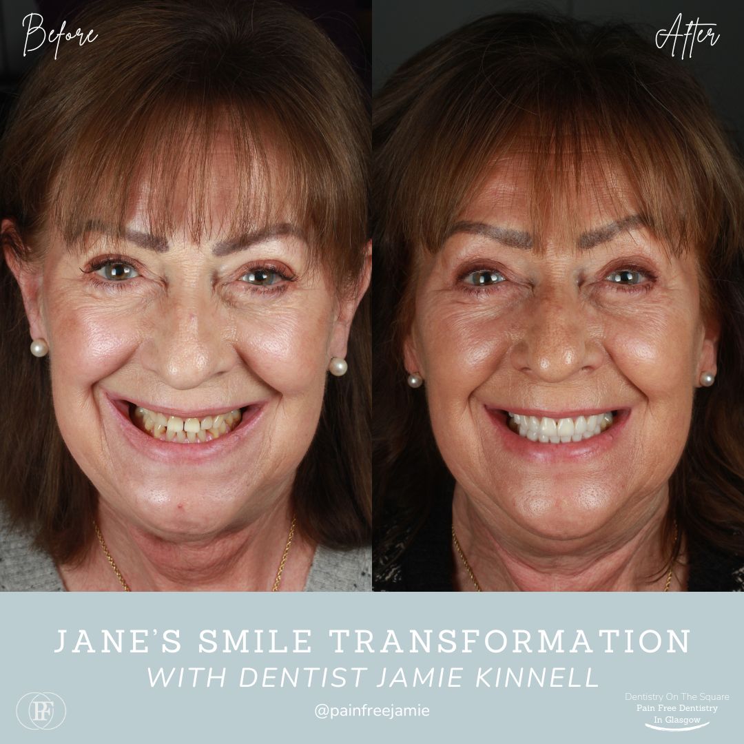 Dentistry On The Square, Pain Free Dentist Glasgow - Jane's Smile Story