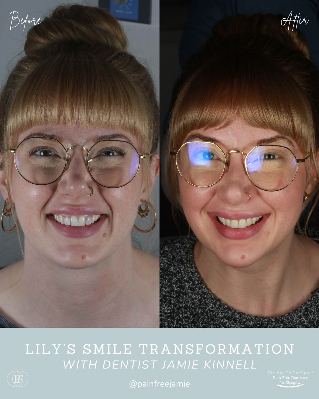 Lily's Smile Story