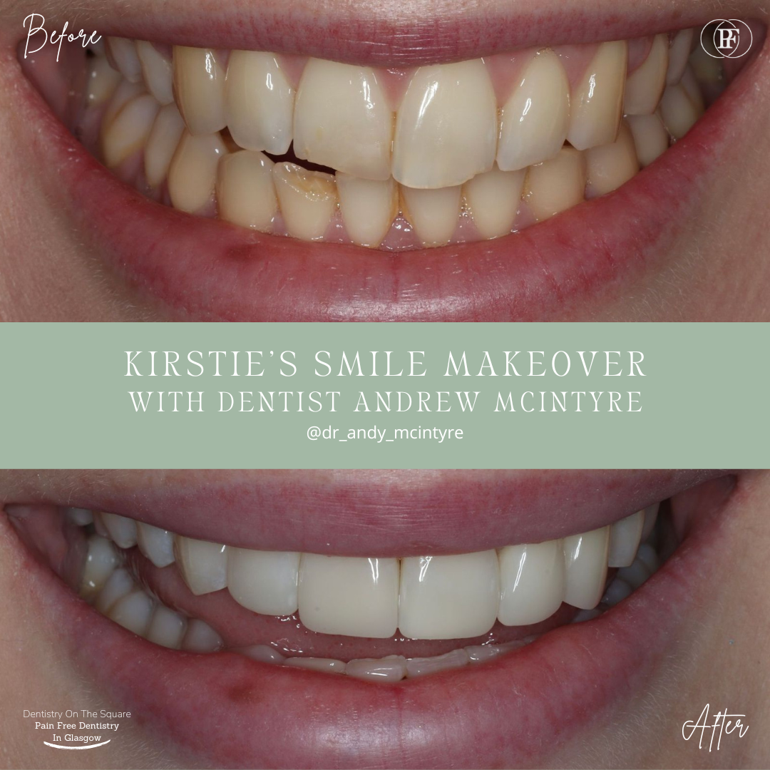 Dentistry On The Square, Pain Free Dentist Glasgow - Kirsty's Smile Story