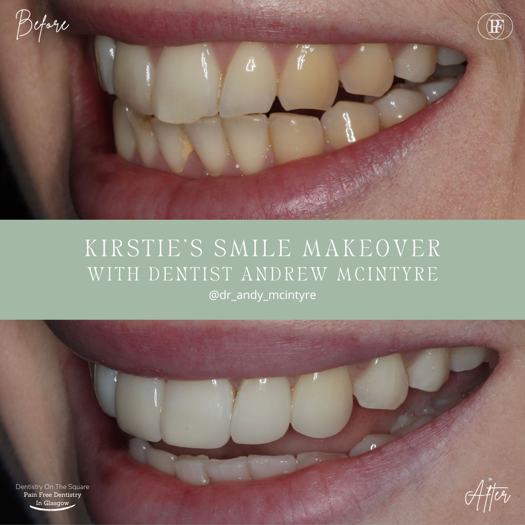 Dentistry On The Square, Pain Free Dentist Glasgow - Kirsty's Smile Story