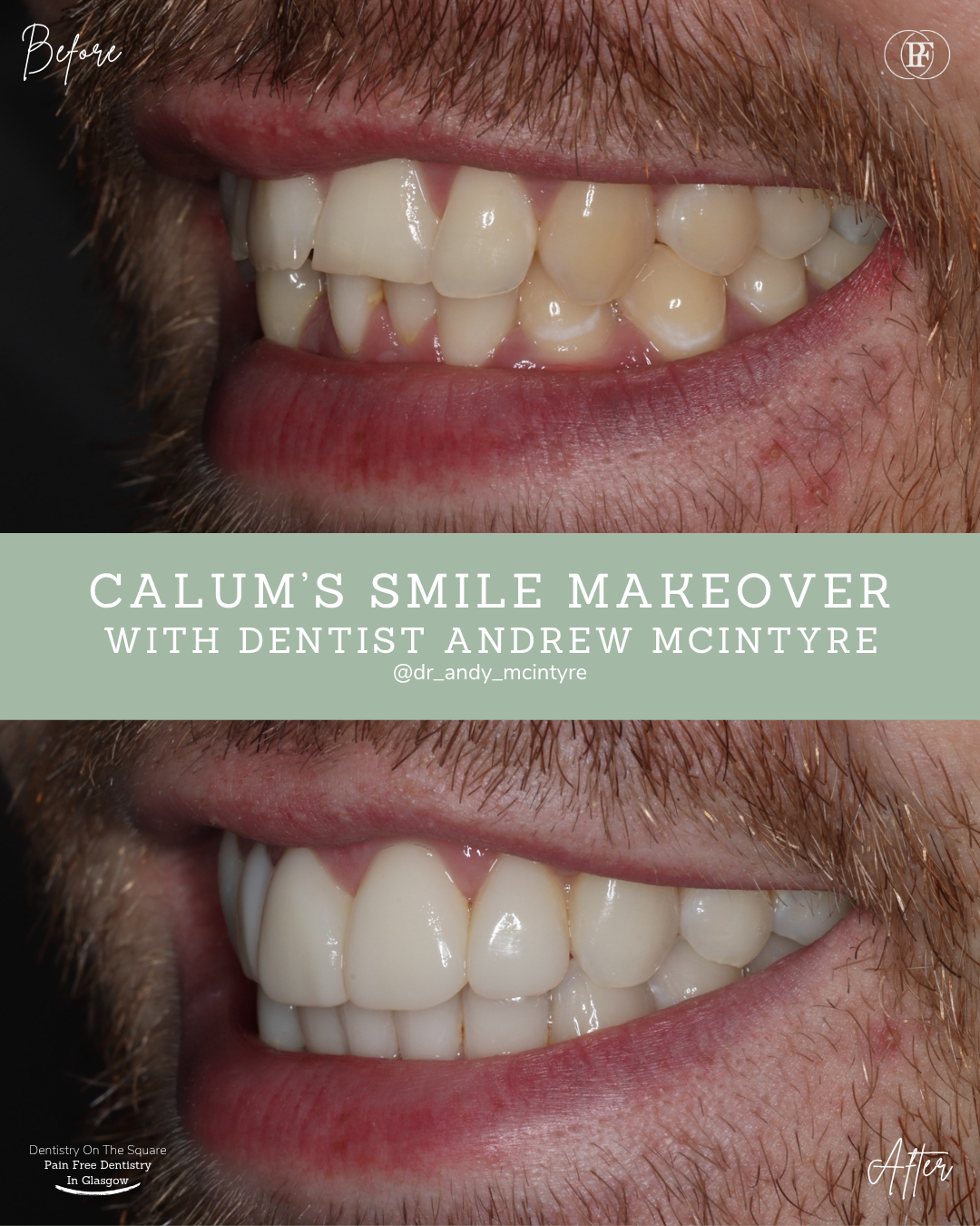 Dentistry On The Square, Pain Free Dentist Glasgow - Calum´s Smile Story