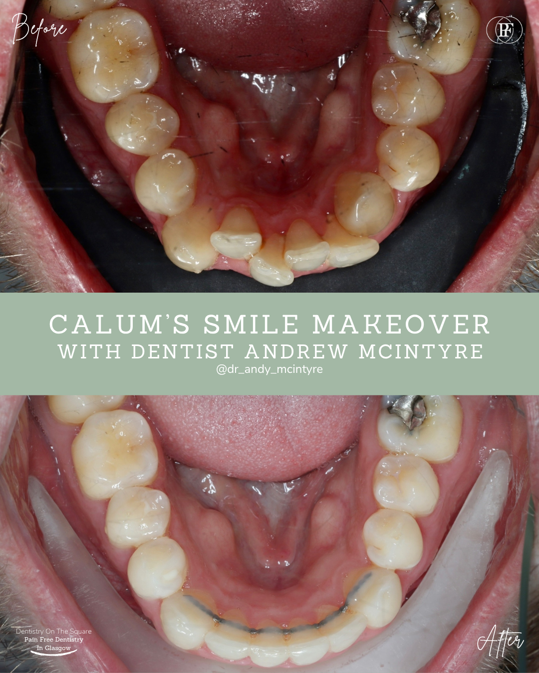 Dentistry On The Square, Pain Free Dentist Glasgow - Calum´s Smile Story